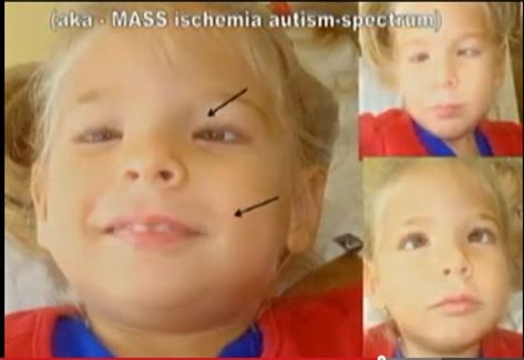 Moulden-video-facial-features-vaccine-damage