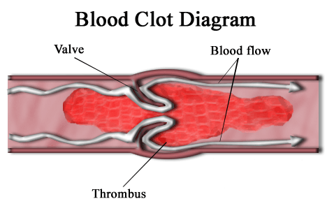 Blood_clot_diagram