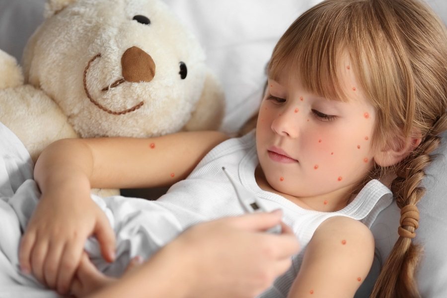 Mother measuring temperature of little girl with red pimples. Chicken pox.