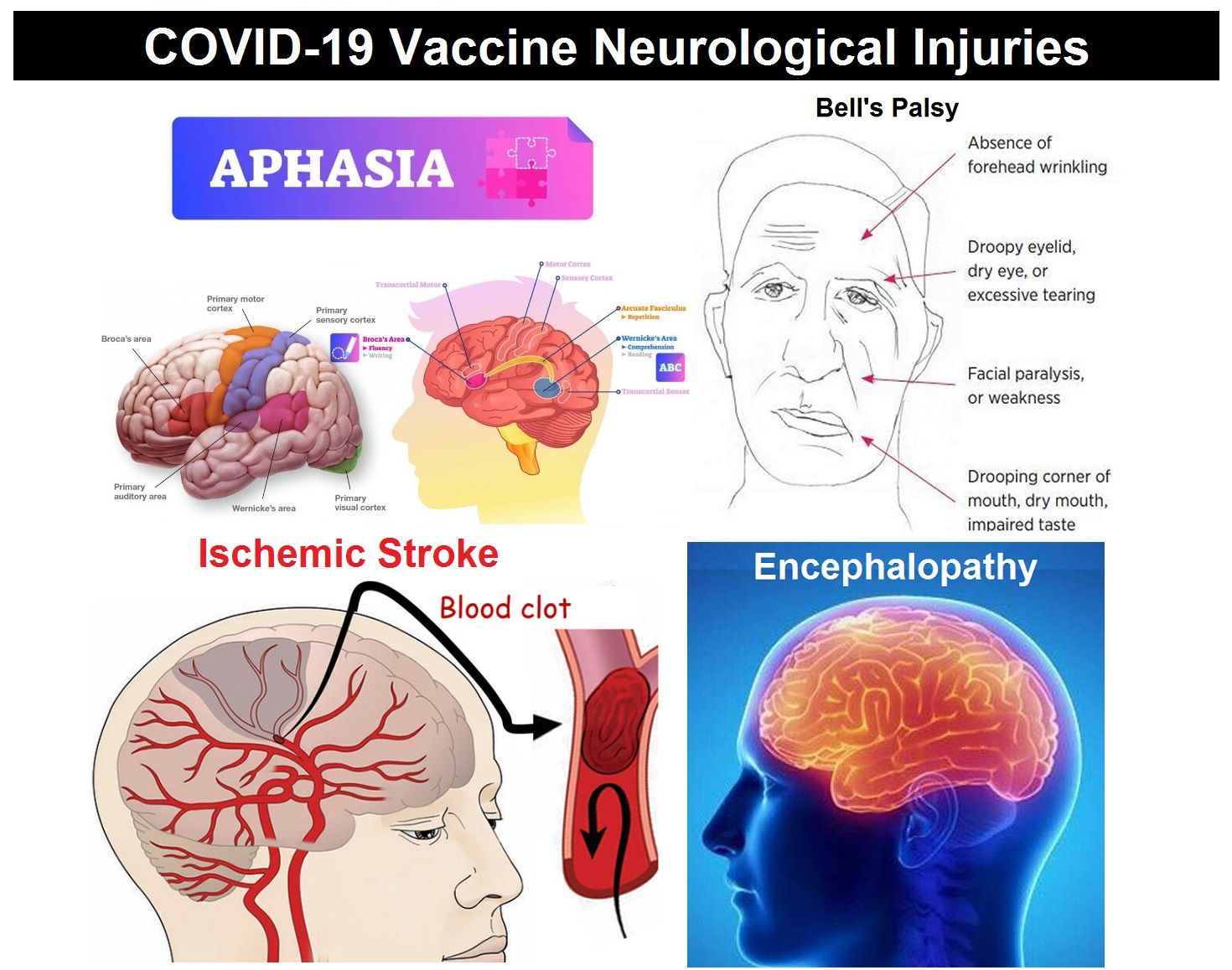 COVID-19-Vaccine-Neurological-Injuries.jpg