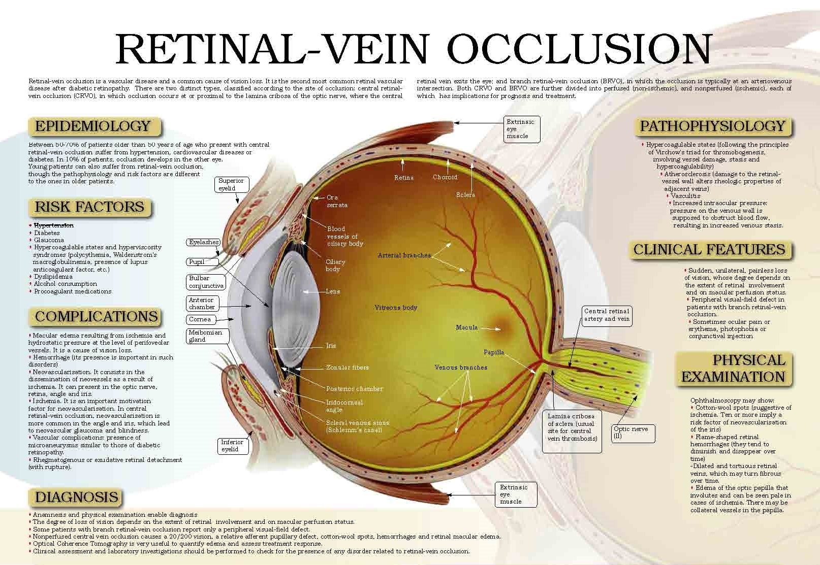 20,000% Increase in Retinal Eye Damage Following COVID-19 Vaccination Retinal-vein-occlusion-2