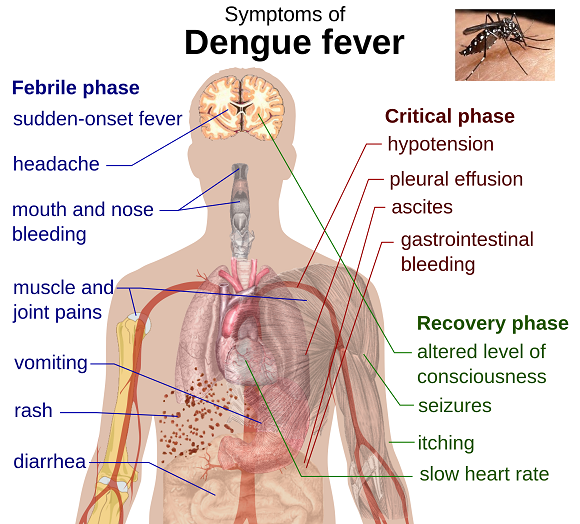 Dengue-Infection-Sanofi-Dengvaxia-Vaccine