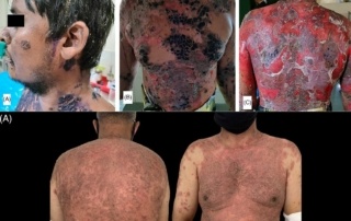 Worse than Monkeypox? Multiple Cases of Skin Diseases Following COVID-19 Vaccination Start Appearing in the Medical Journals