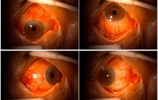 20,000% Increase in Retinal Eye Damage Following COVID-19 Vaccination